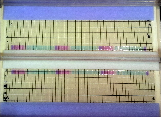 Urinary Proteins 2 x 52 samples